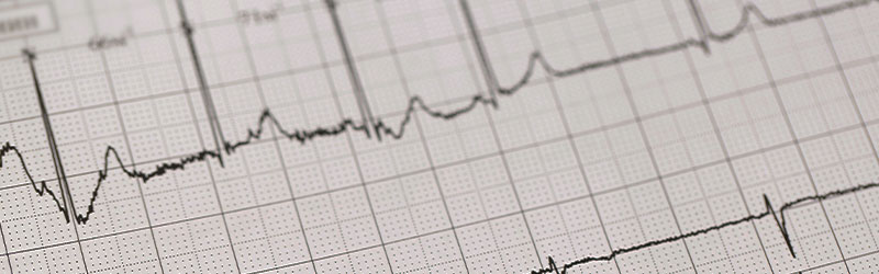 Electrocardiogram