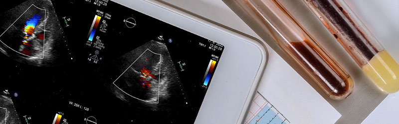 Echocardiogram